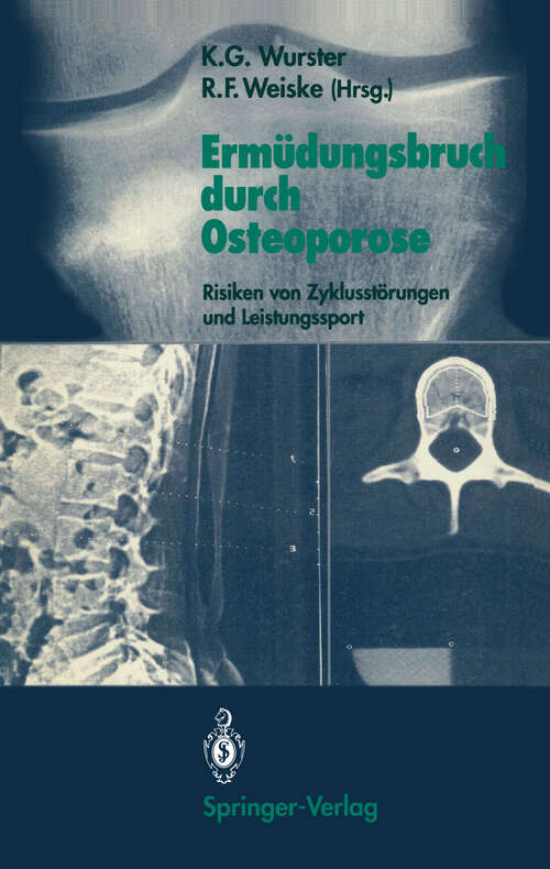 Book cover of Ermüdungsbruch durch Osteoporose: Risiken von Zyklusstörungen und Leistungssport (1991)