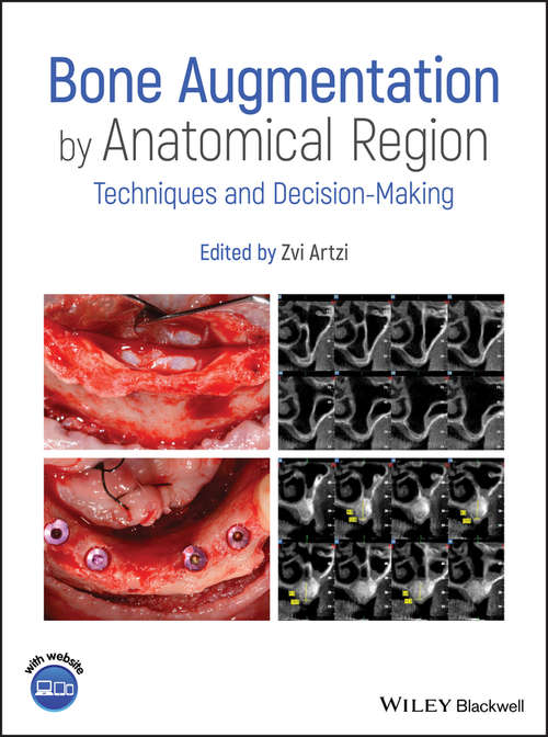Book cover of Bone Augmentation by Anatomical Region: Techniques and Decision-Making