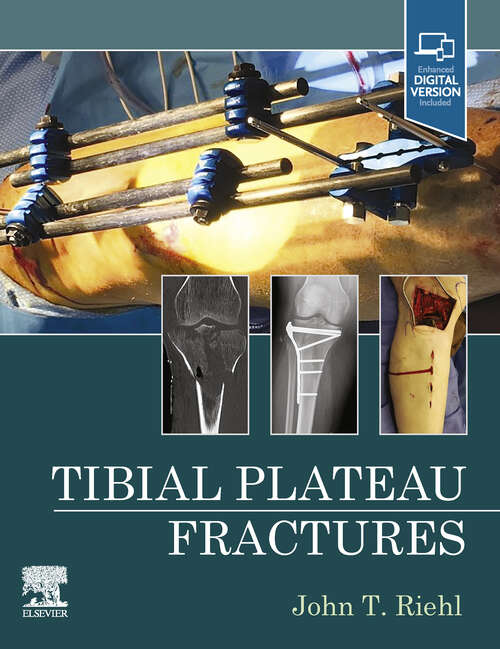 Book cover of Tibial Plateau Fractures - E-Book