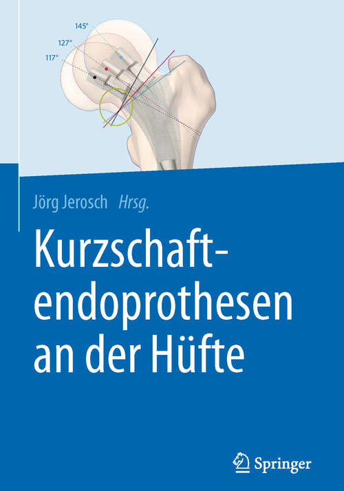 Book cover of Kurzschaftendoprothesen an der Hüfte (1. Aufl. 2017)