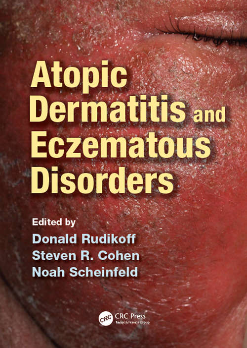 Book cover of Atopic Dermatitis and Eczematous Disorders
